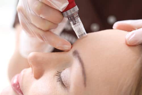 Cure de 3 séances Microneedling