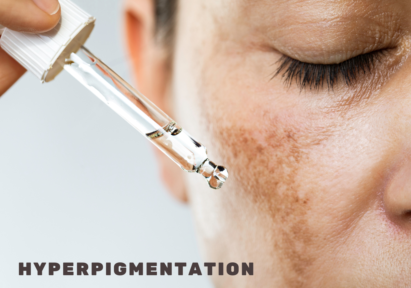 DIRE ADIEU À L'HYPERPIGMENTATION AVEC LES COSMETIQUES CORÉENS