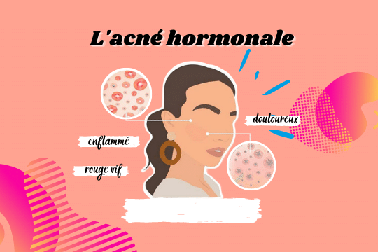 Comment gérer l'acné hormonale ?
